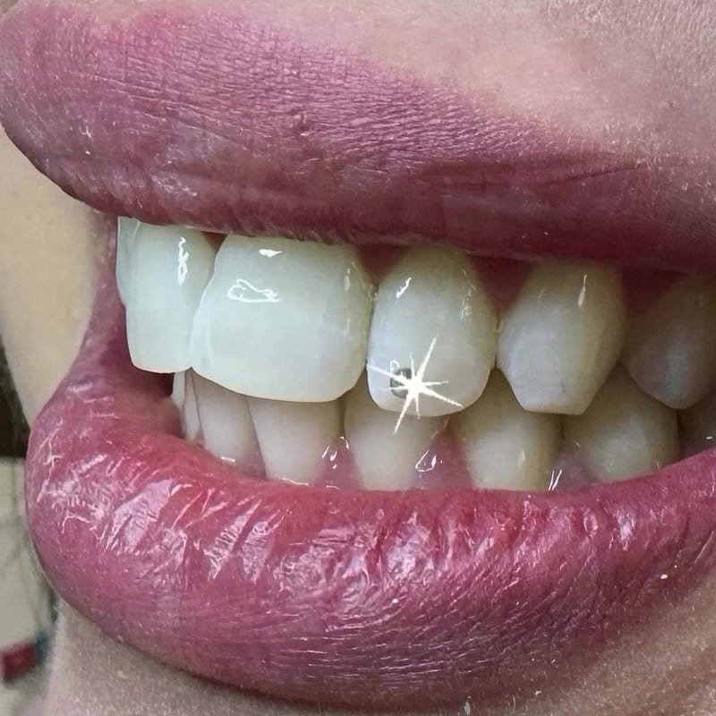 Zahnschmuck, Nahaufnahme eines funkelnden Steinchens