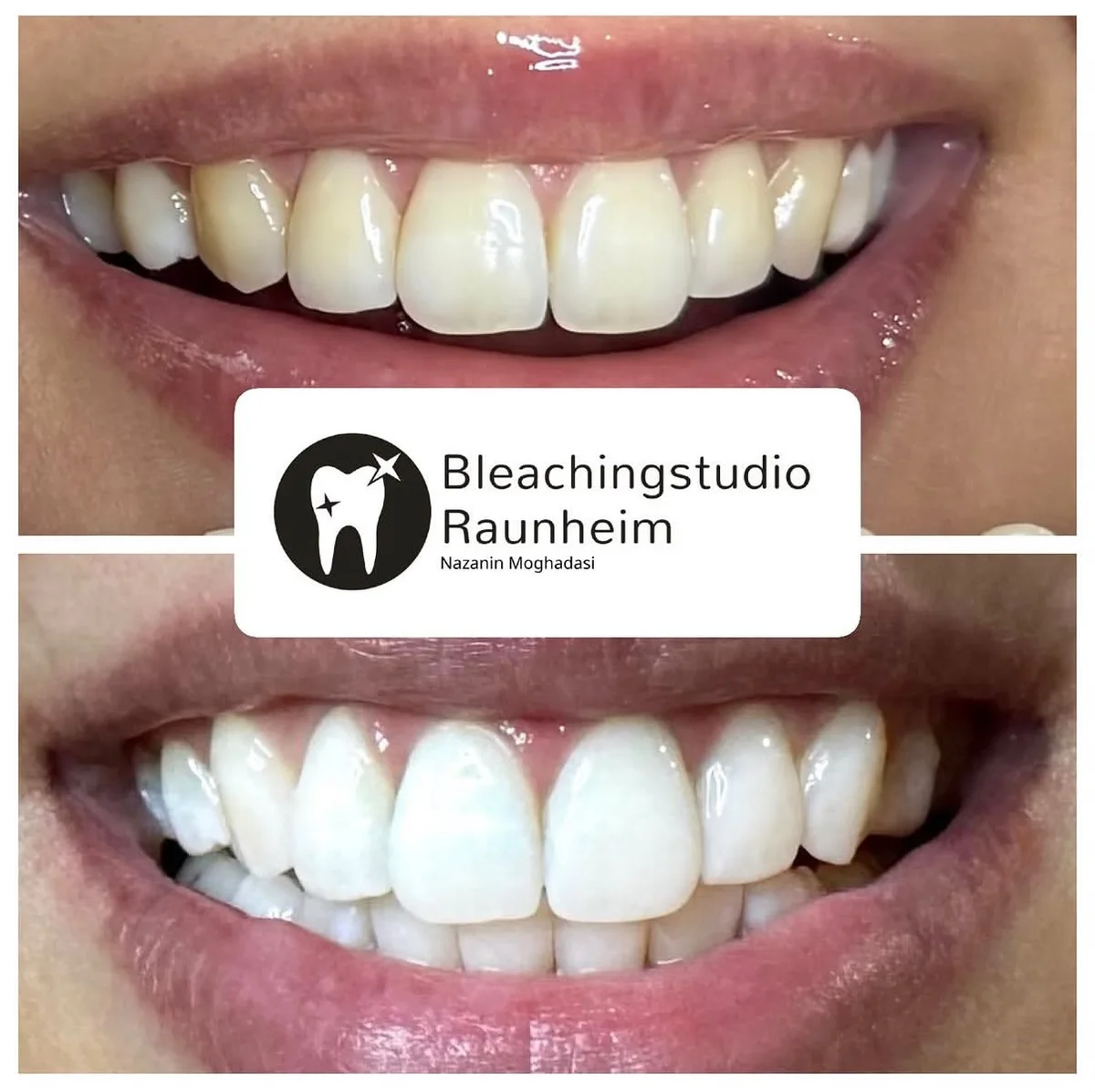 Nahaufnahme eines Lächelns vor und nach dem kosmetischen Zahnbleaching im Bleachingstudio Raunheim